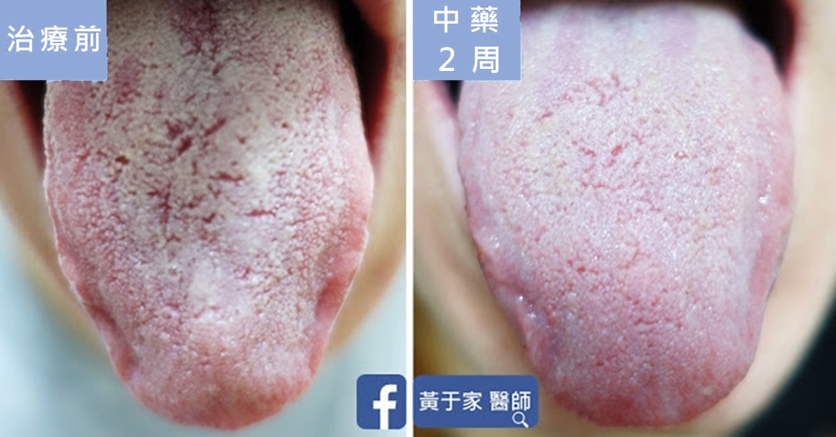 舌象比對,左標示「治療前」,右標示「中藥 2 周」