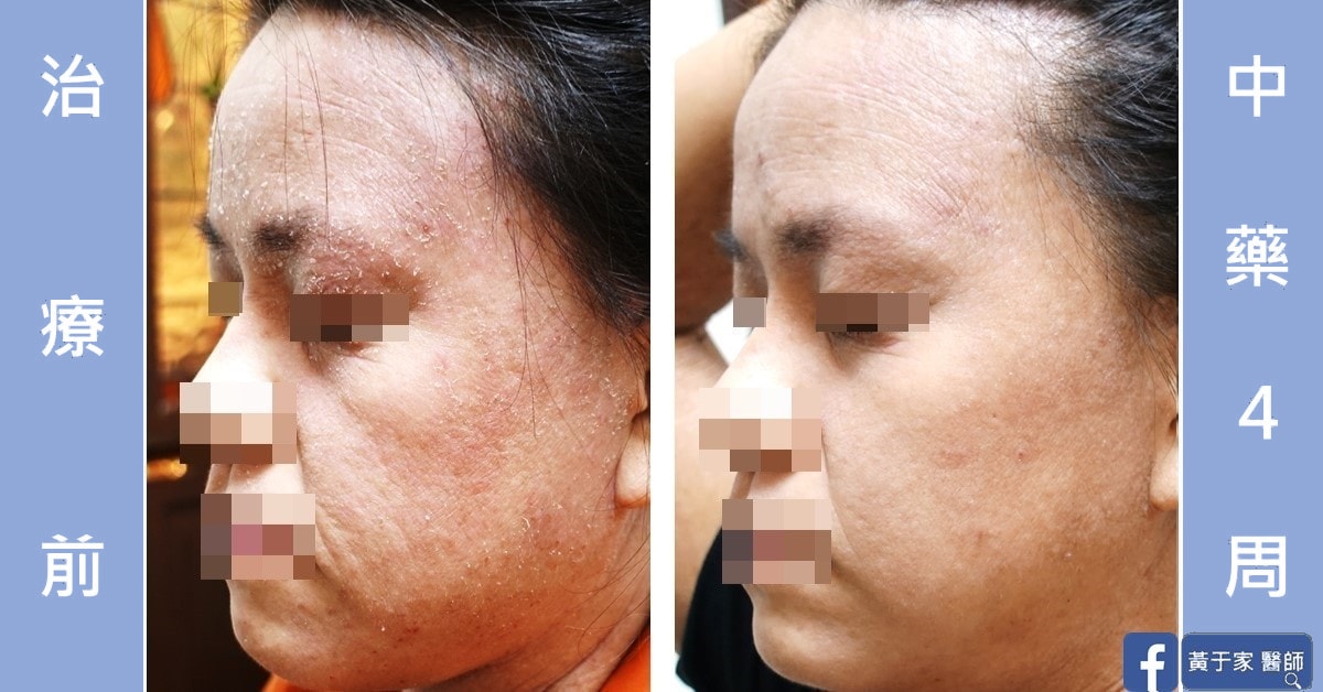 同一位患者左側臉的比對,左標示「治療前」,右標示「中藥 4 周」,眼口已做去識別處理