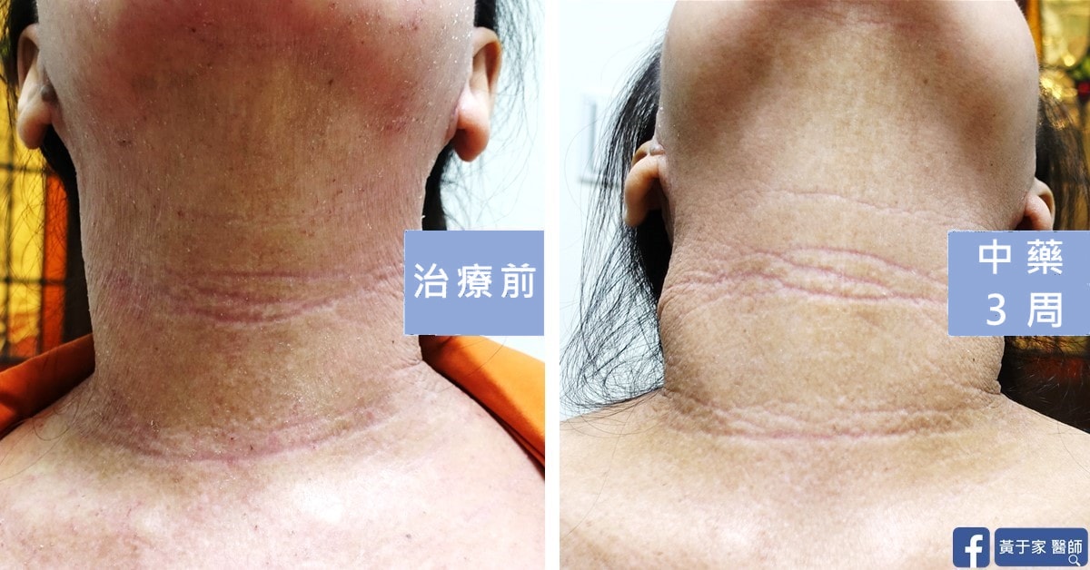 同一位患者頸部的比對,左標示「治療前」,右標示「中藥 3 周」