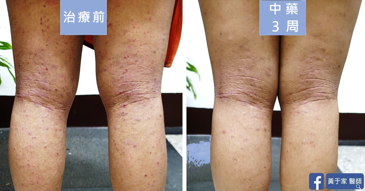 同一位患者小腿後側的比對,左標示「治療前」,右標示「中藥 3 周」