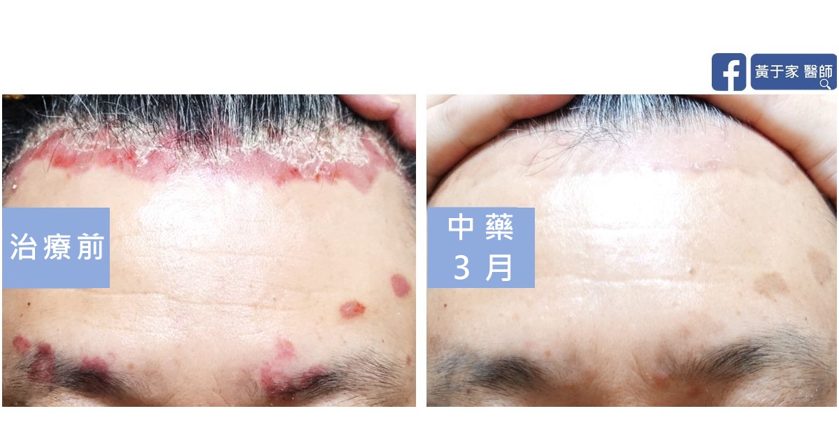 同一位患者額頭與前髮際的比對,左標示「治療前」,髮際與眉間有鮮紅脫屑的乾癬斑塊;右標示「中藥 3 月」
