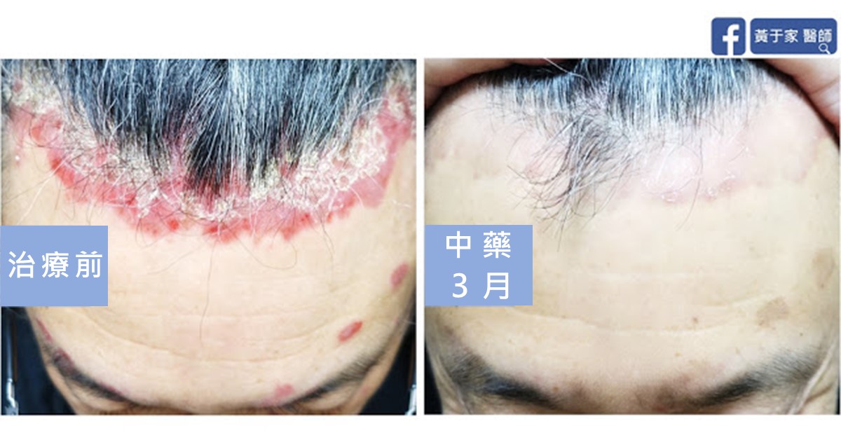 同一位患者低頭時額頭與前髮際的比對,左標示「治療前」,髮際布滿鮮紅鱗屑斑塊;右標示「中藥 3 月」