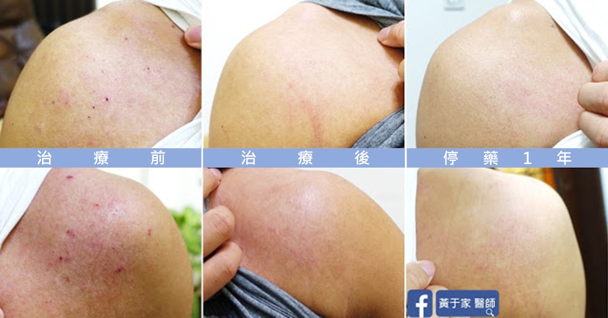 同一位患者肩頭與上臂的六格比對，上下兩列依序標示「治療前」「治療後」「停藥 1 年」