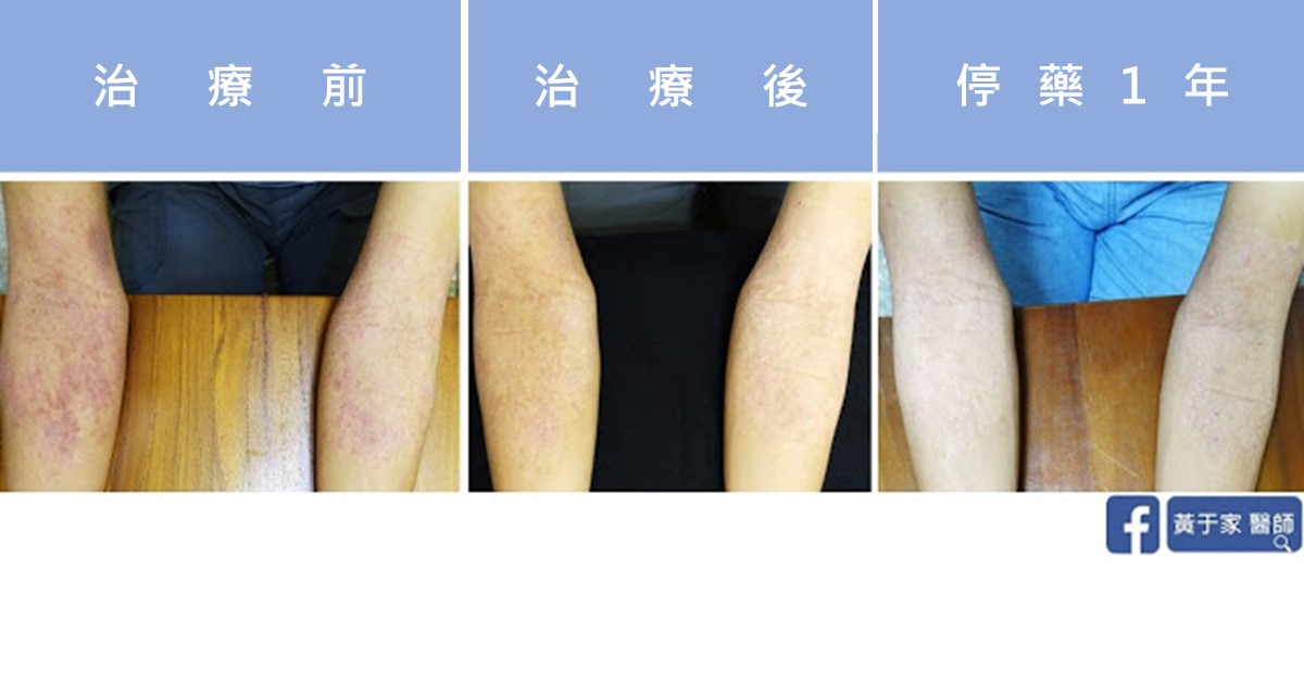同一位患者雙前臂的三張比對，依序標示「治療前」「治療後」「停藥 1 年」