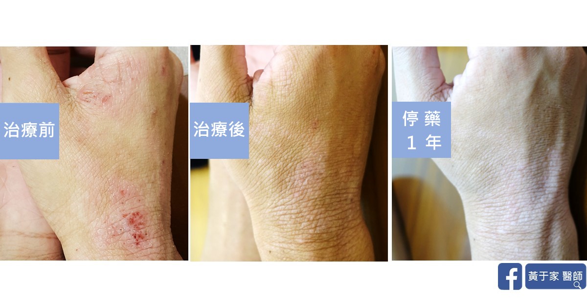 同一位患者手背與虎口的三張比對，依序標示「治療前」「治療後」「停藥 1 年」