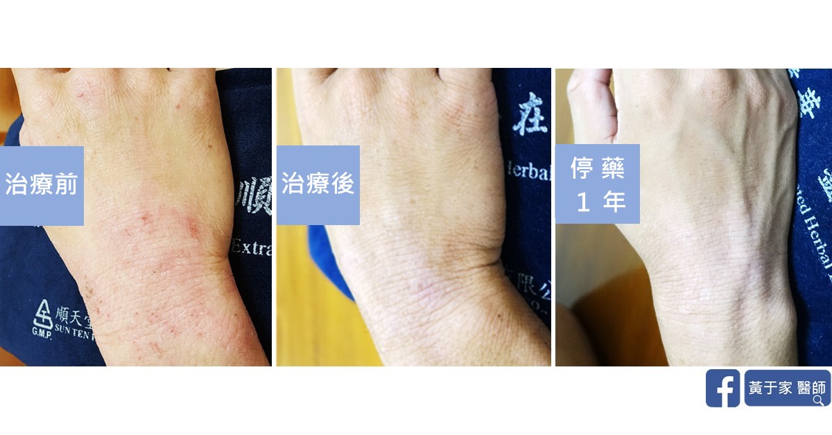 同一位患者另一隻手背與手腕的三張比對，依序標示「治療前」「治療後」「停藥 1 年」