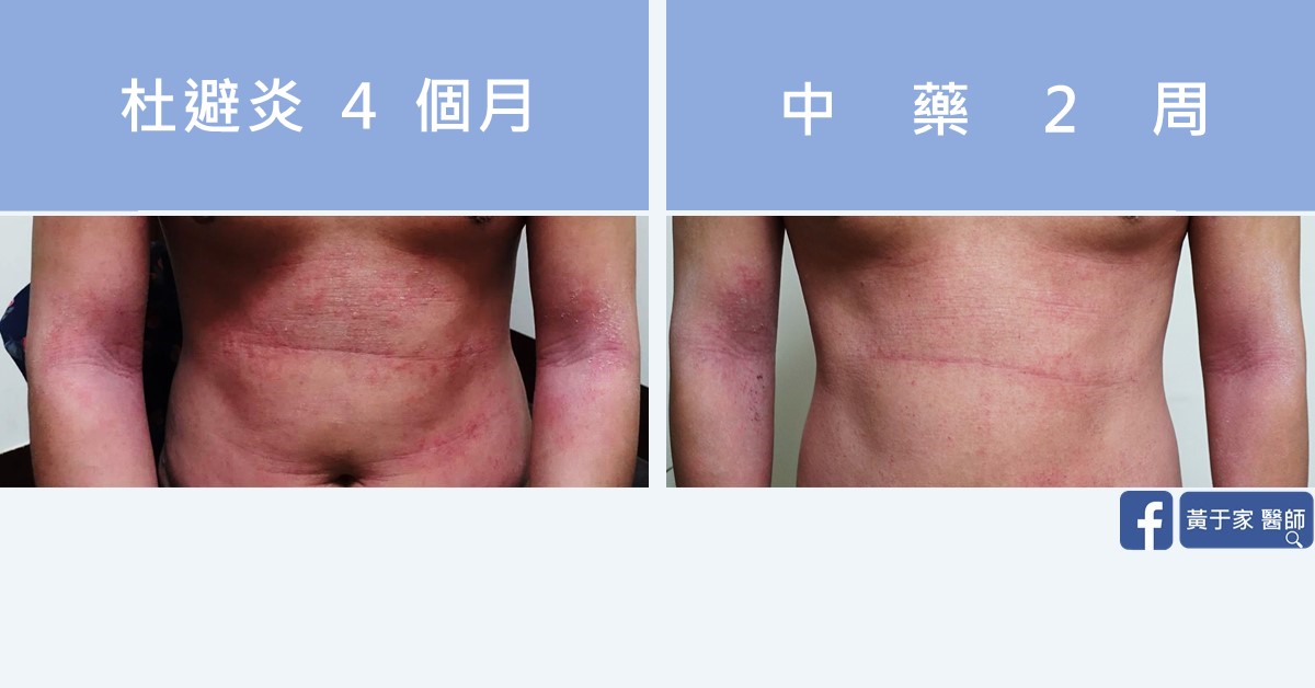 同一位患者的皮膚比對,左標示「杜避炎 4 個月」,右標示「中藥 2 周」