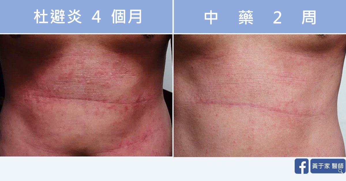 同一位患者的皮膚比對,左標示「杜避炎 4 個月」,右標示「中藥 2 周」
