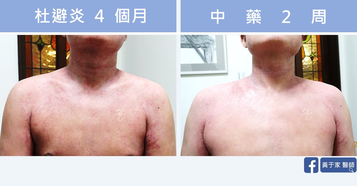 同一位患者的皮膚比對,左標示「杜避炎 4 個月」,右標示「中藥 2 周」