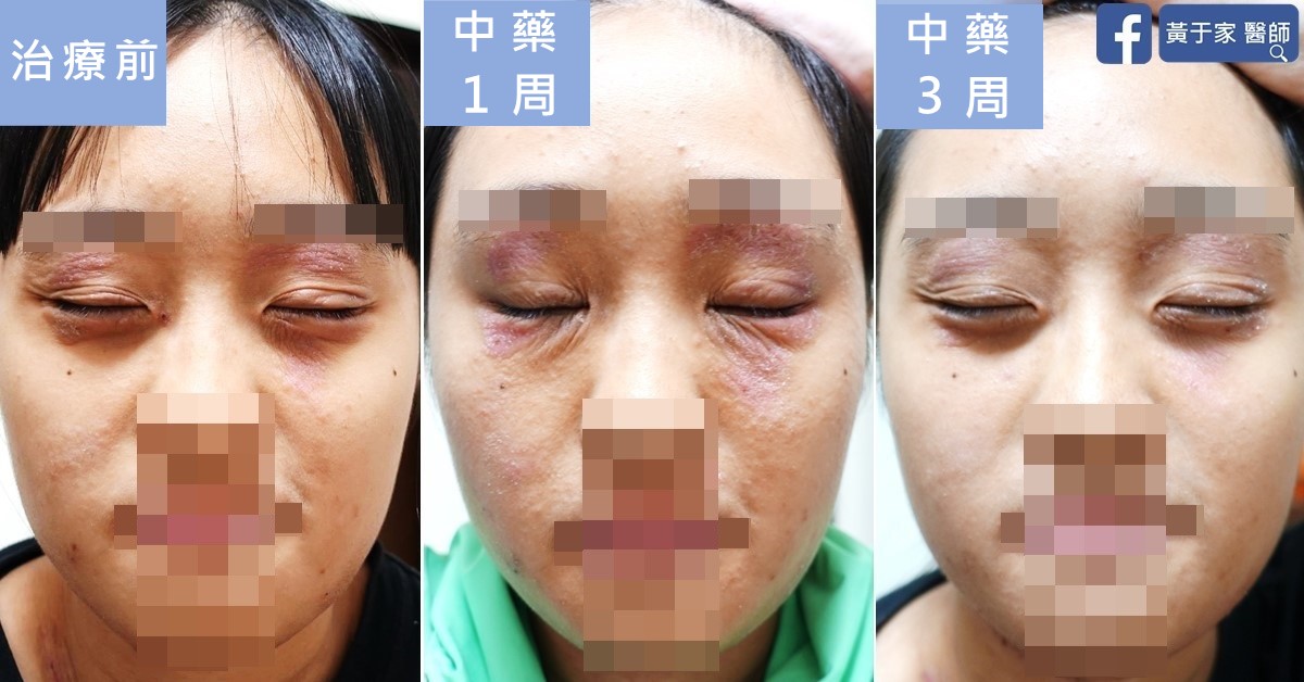 同一位少女閉眼正面臉部的三張比對,依序標示「治療前」「中藥 1 周」「中藥 3 周」,中藥 1 周時眼周泛紅加重