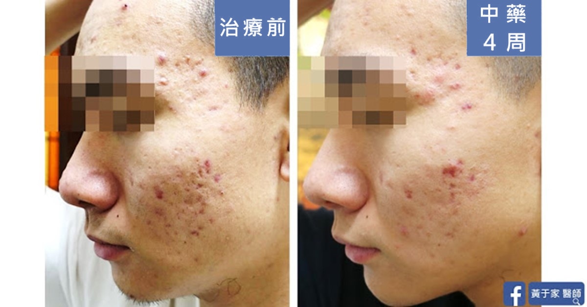 誰說治痘就只是在調經？帥氣男大生（圖 1）