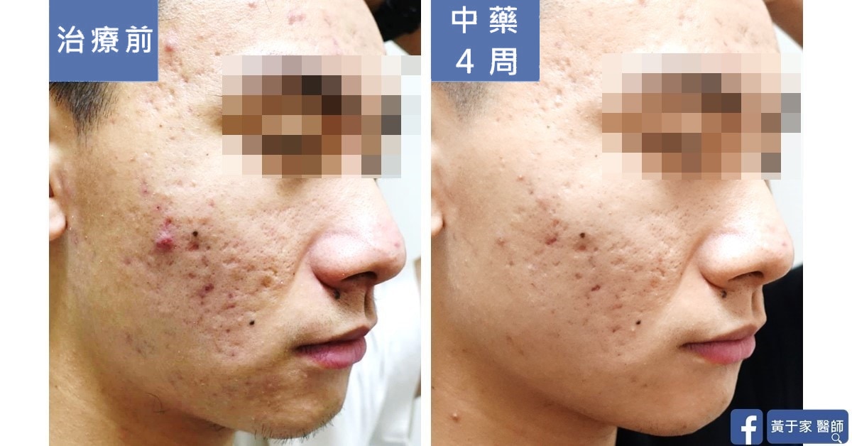 誰說治痘就只是在調經？帥氣男大生（圖 2）