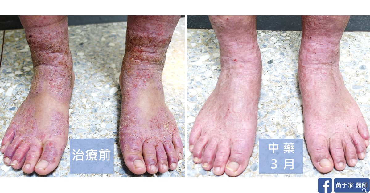 同一位患者雙腳踝與腳背正面的比對,左標示「治療前」,右標示「中藥 3 月」