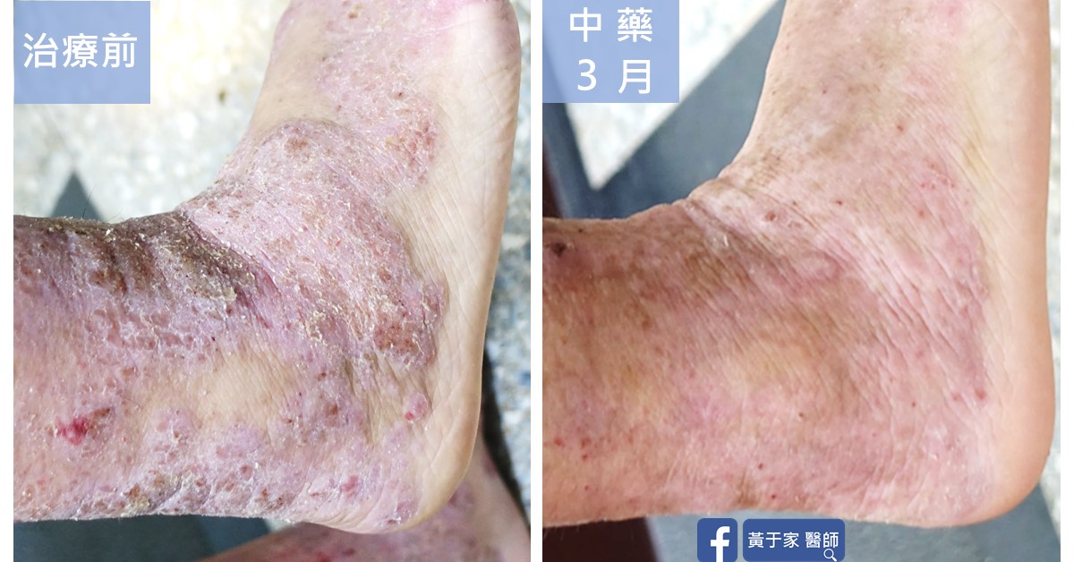 同一位患者腳踝內側的近照比對,左標示「治療前」,可見增厚結痂;右標示「中藥 3 月」