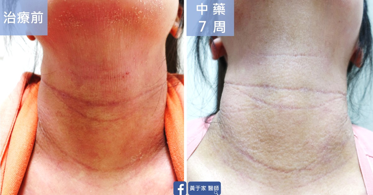 同一位患者頸部正面的比對,左標示「治療前」,泛紅脫屑;右標示「中藥 7 周」