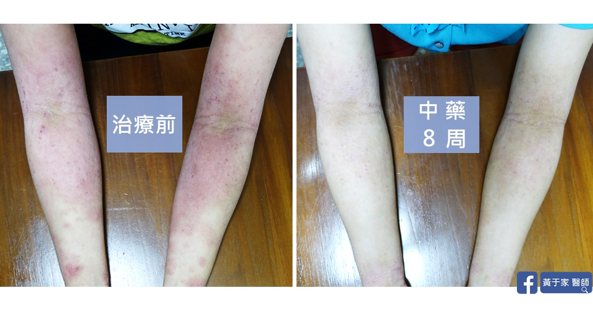 同一位患者雙前臂與肘窩的比對,左標示「治療前」,右標示「中藥 8 周」