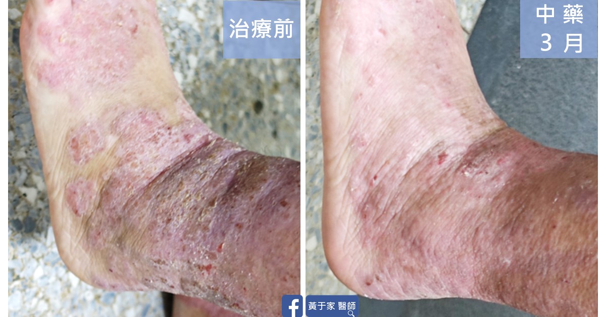 同一位患者另一側腳踝的近照比對,左標示「治療前」,右標示「中藥 3 月」