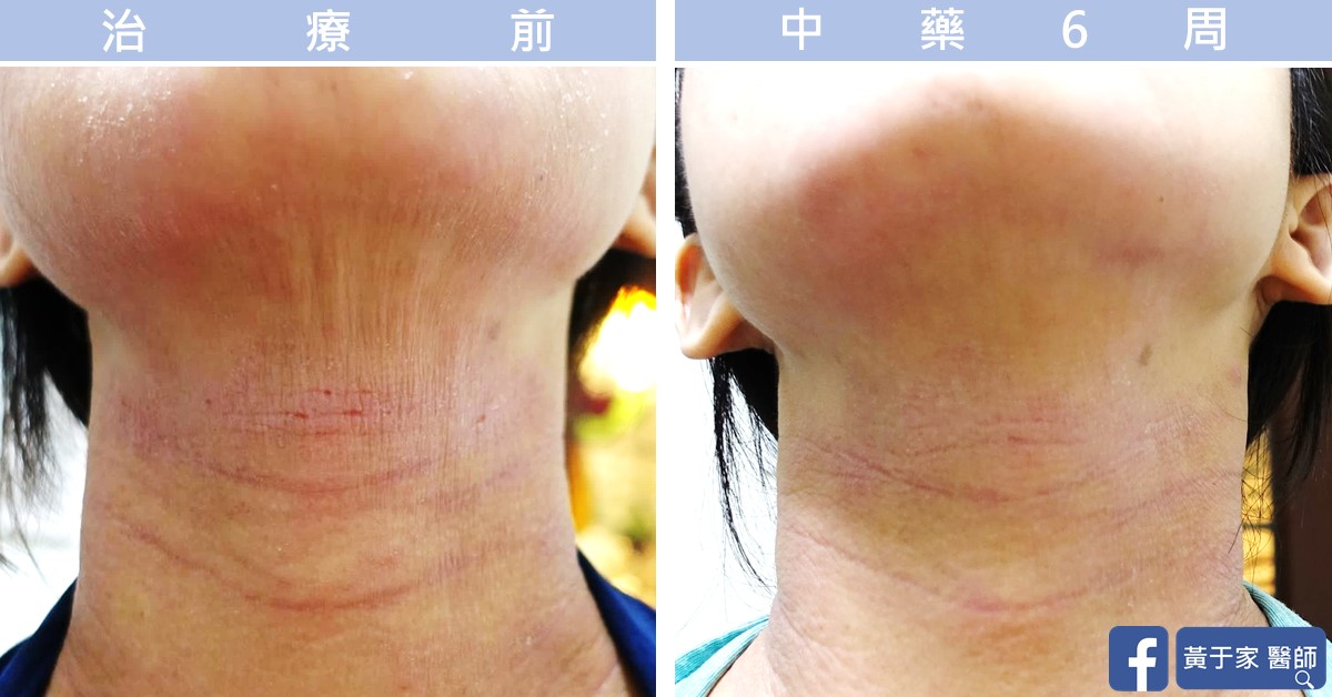 同一位患者頸部正面的比對,左標示「治療前」,右標示「中藥 6 周」