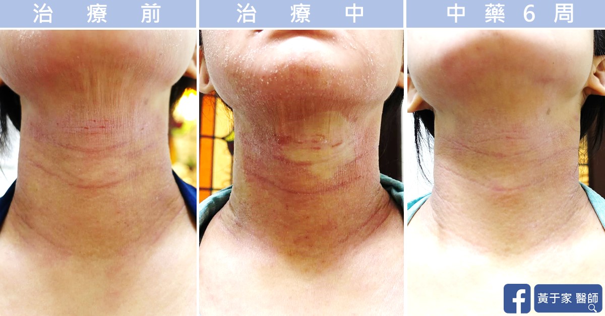 同一位患者頸部正面的三張比對,依序標示「治療前」「治療中」「中藥 6 周」