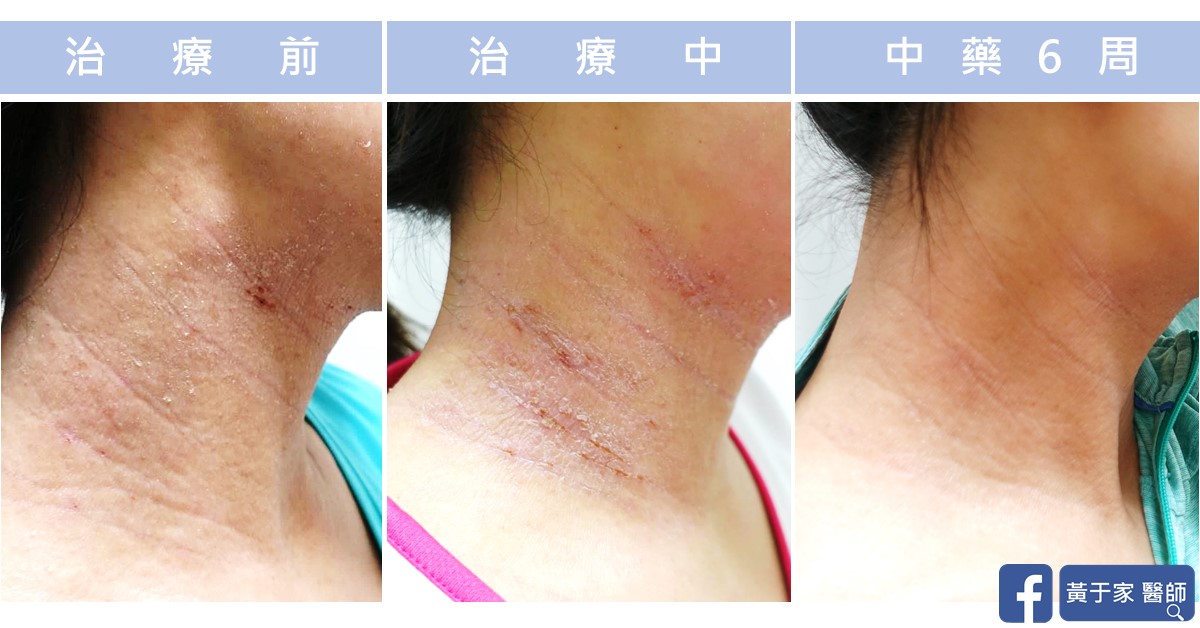 同一位患者頸部側面的三張比對,依序標示「治療前」「治療中」「中藥 6 周」