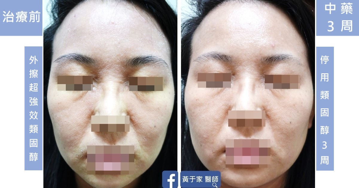 另一位年輕女性患者正面臉部的比對,左標示「治療前・外擦超強效類固醇」,右標示「中藥 3 周・停用類固醇 3 周」