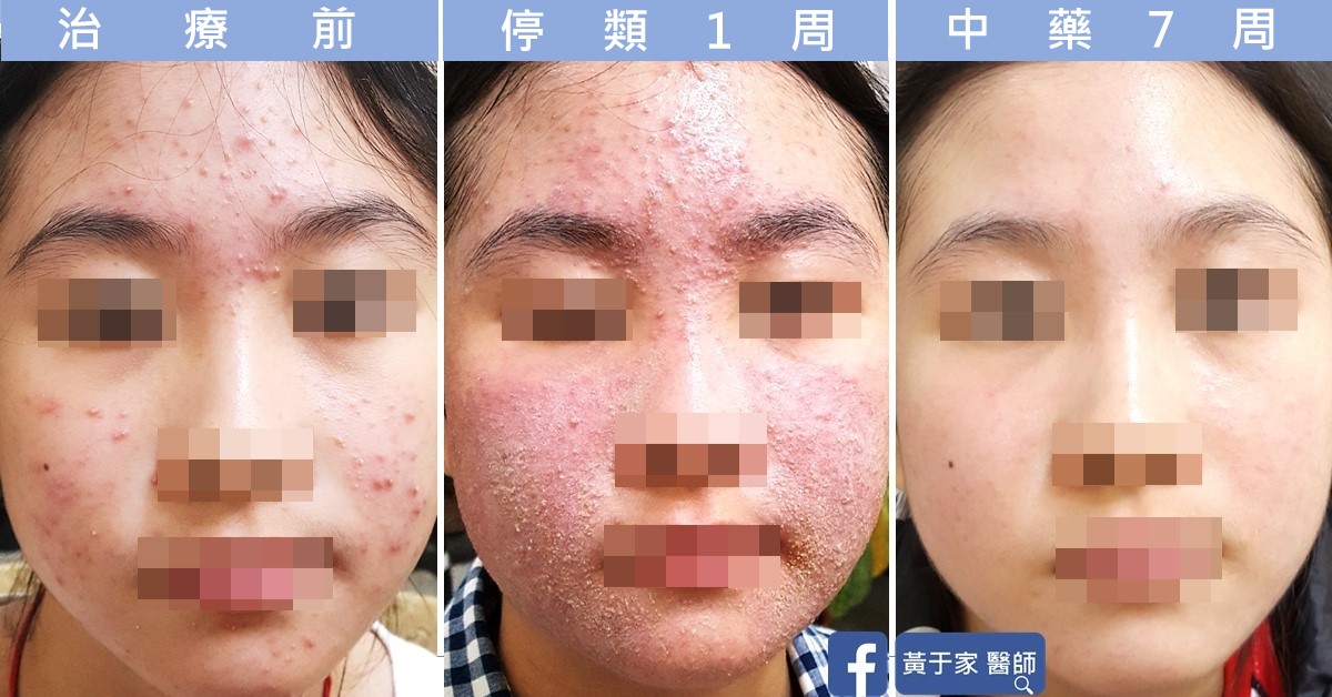 同一位青少女患者正面臉部的三張比對,依序標示「治療前」「停類 1 週」「中藥 7 周」,停用類固醇一週時滿臉泛紅脫屑