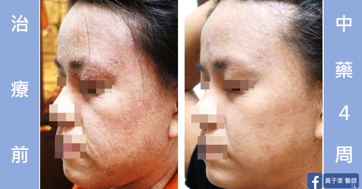 一位患者右側臉的比對,左標示「治療前」,額頭與臉頰脫屑;右標示「中藥 4 周」