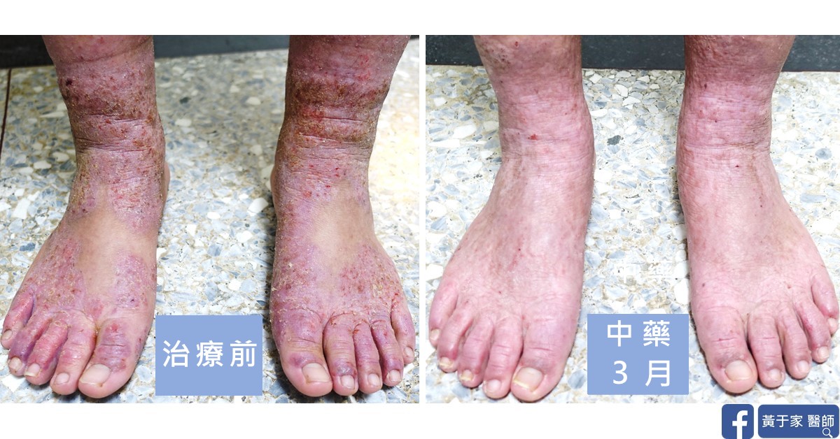 一位患者雙腳踝與腳背正面的比對,左標示「治療前」,右標示「中藥 3 月」