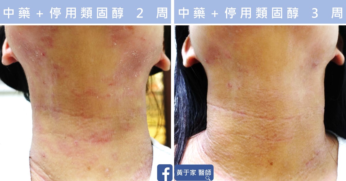 一位患者頸部的比對,左標示「中藥+停用類固醇 2 周」,右標示「中藥+停用類固醇 3 周」