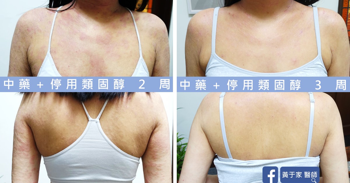 同一位患者胸前與背部的比對,左標示「中藥+停用類固醇 2 周」,右標示「中藥+停用類固醇 3 周」