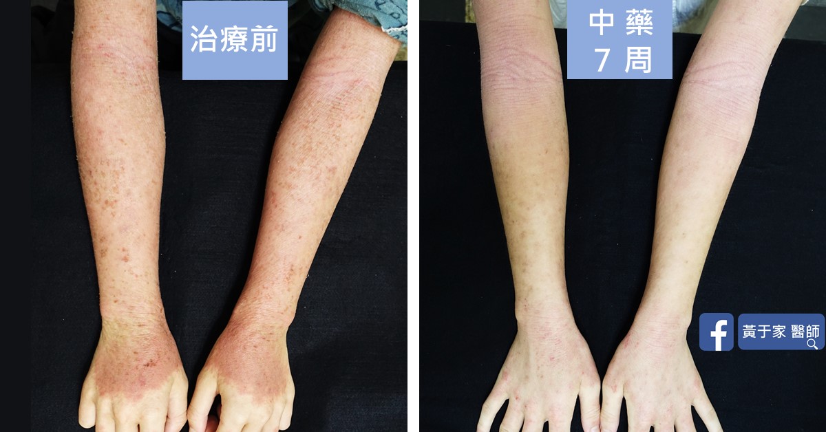 一位患者雙前臂與手背的比對,左標示「治療前」,右標示「中藥 7 周」