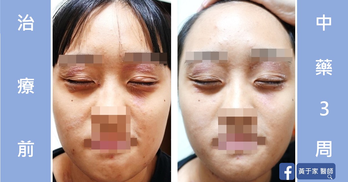 一位患者閉眼正面臉部的比對,左標示「治療前」,眼周泛紅;右標示「中藥 3 周」