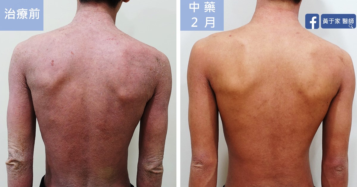 同一位患者背部的比對,左標示「治療前」,泛紅脫屑;右標示「中藥 2 月」