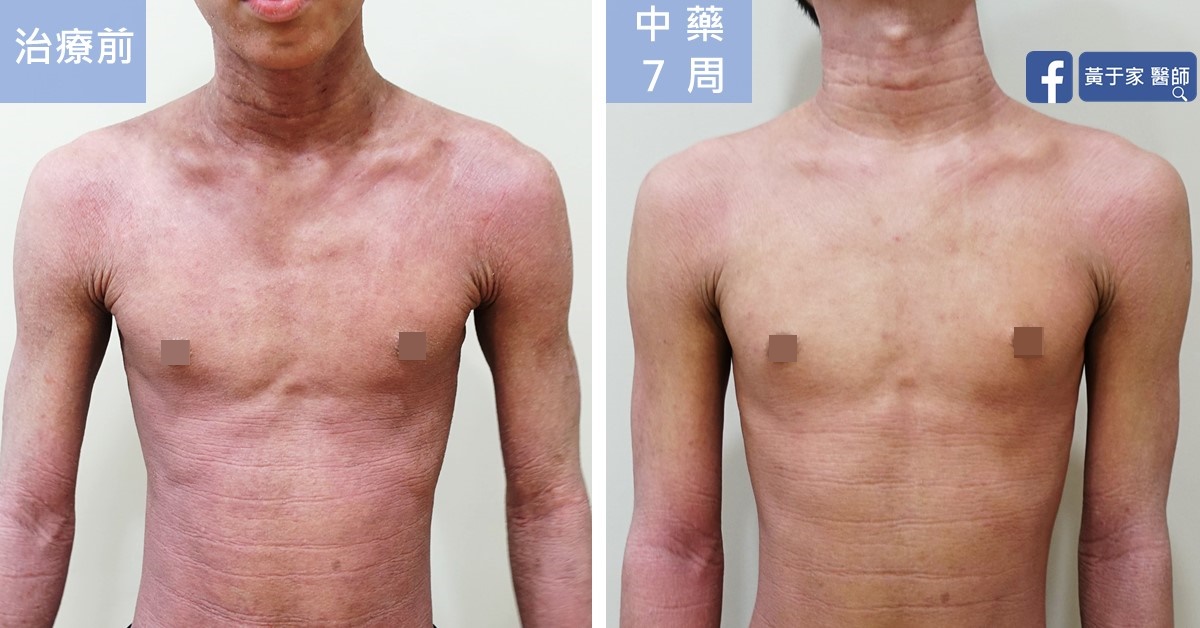 同一位患者胸前與上臂正面的比對,左標示「治療前」,右標示「中藥 7 周」