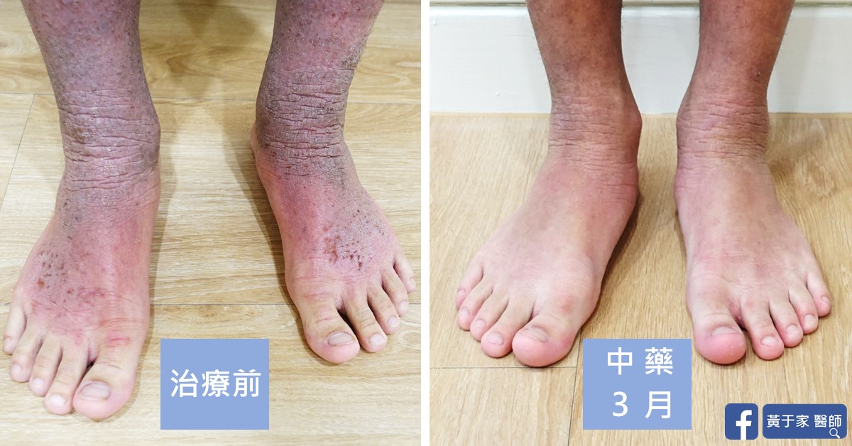 同一位患者雙腳踝與腳背的比對,左標示「治療前」,腳踝皺褶泛紅;右標示「中藥 3 月」