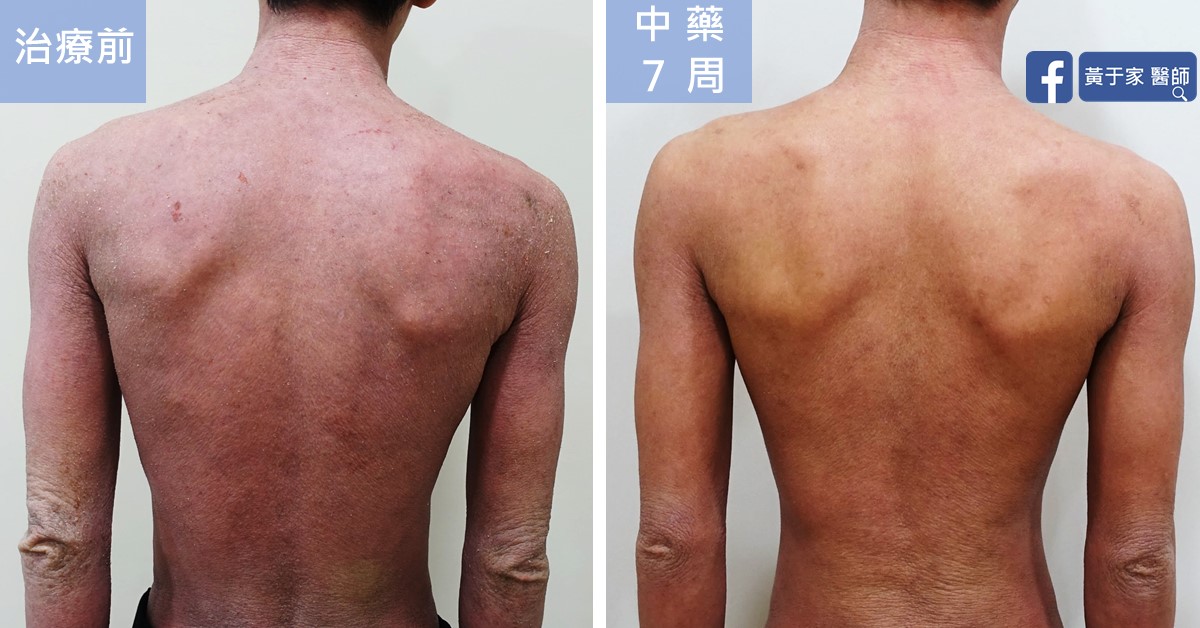 同一位患者背部的比對,左標示「治療前」,右標示「中藥 7 周」