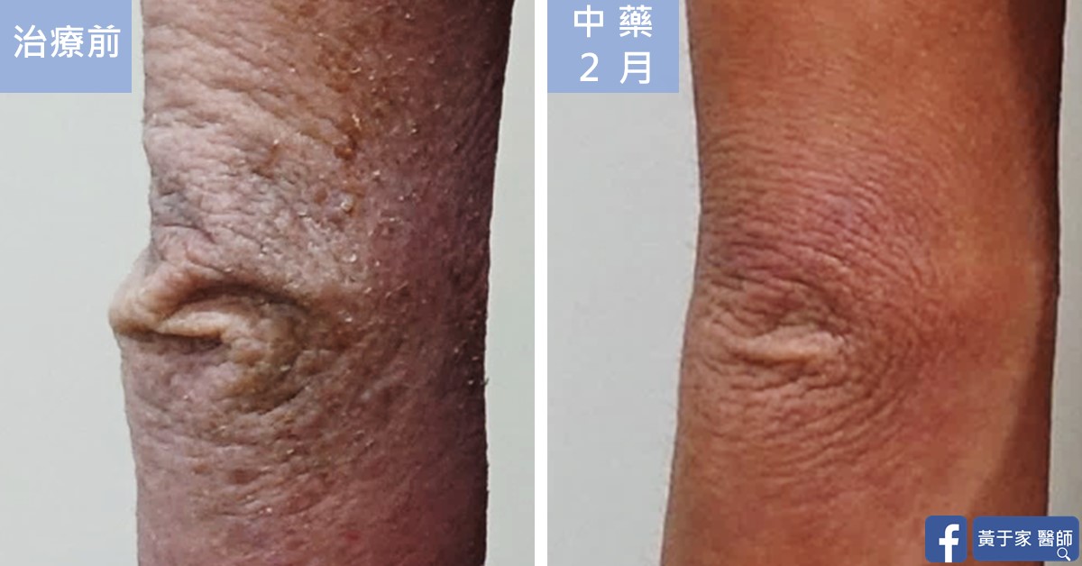 同一位患者手肘關節皺褶的近照比對,左標示「治療前」,皺褶明顯伴脫屑;右標示「中藥 2 月」