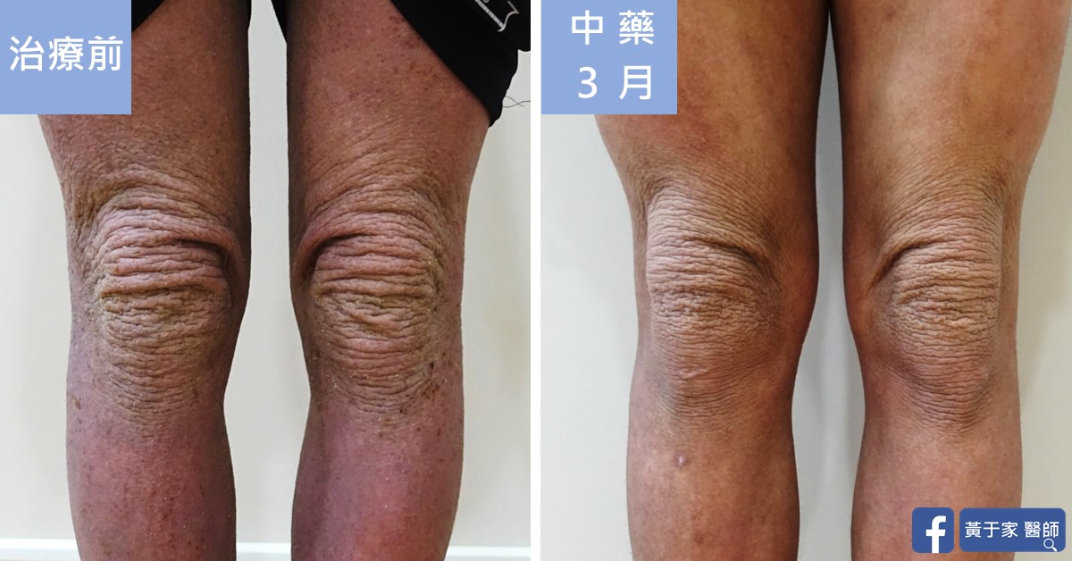 同一位患者雙膝正面的比對,左標示「治療前」,膝部皺褶明顯;右標示「中藥 3 月」