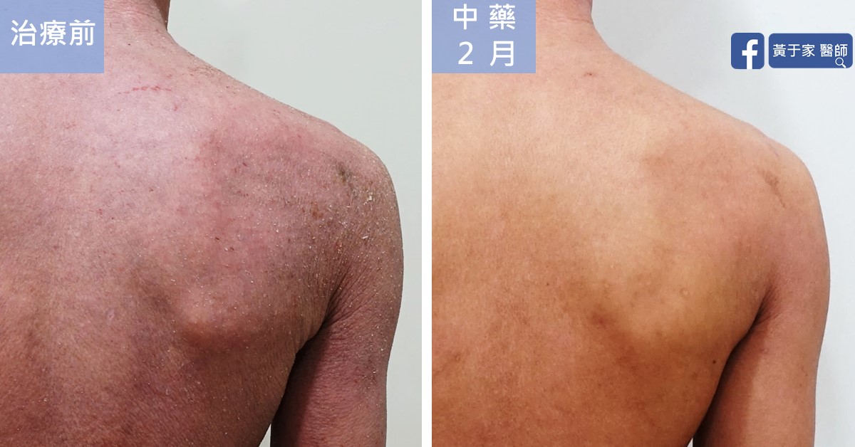 同一位患者右肩背部的近照比對,左標示「治療前」,右標示「中藥 2 月」