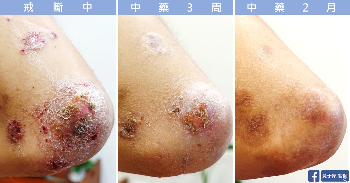 類固醇戒斷患者治療前後皮膚外觀比對（1）