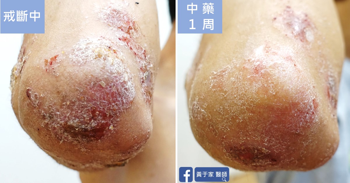 類固醇戒斷患者治療前後皮膚外觀比對（2）