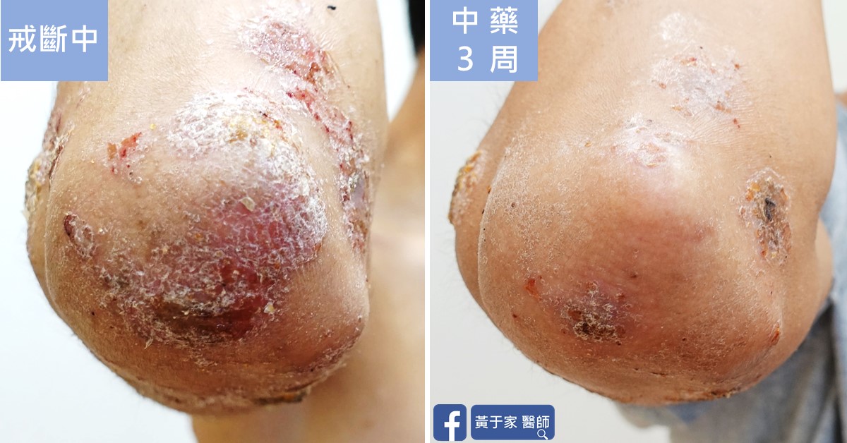 類固醇戒斷患者治療前後皮膚外觀比對（3）