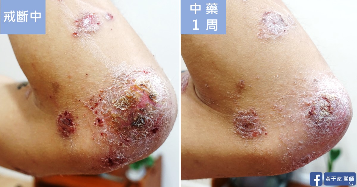 類固醇戒斷患者治療前後皮膚外觀比對（4）