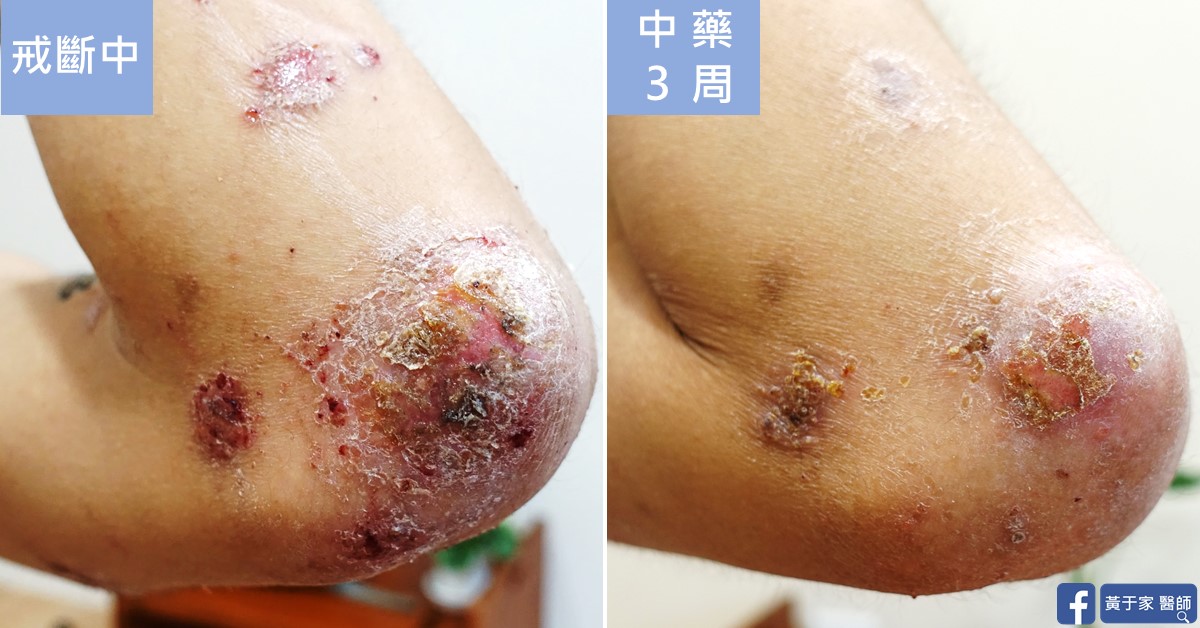 類固醇戒斷患者治療前後皮膚外觀比對（5）