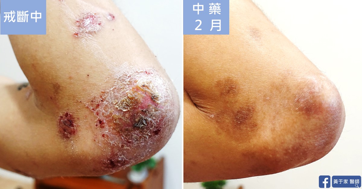 類固醇戒斷患者治療前後皮膚外觀比對（6）