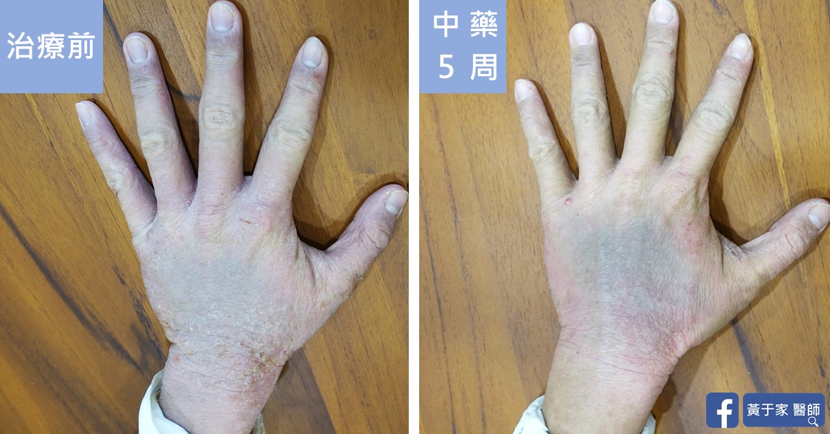 同一位患者手背的比對,左標示「治療前」,右標示「中藥 5 周」