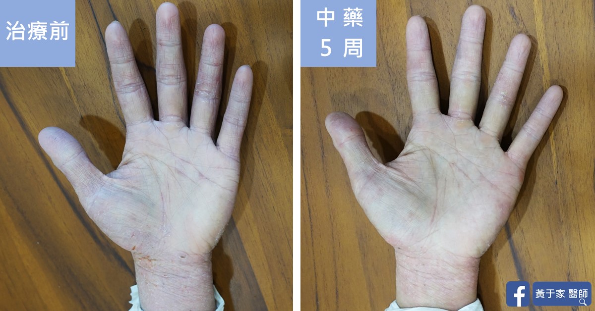 同一位患者皮膚的治療前後比對