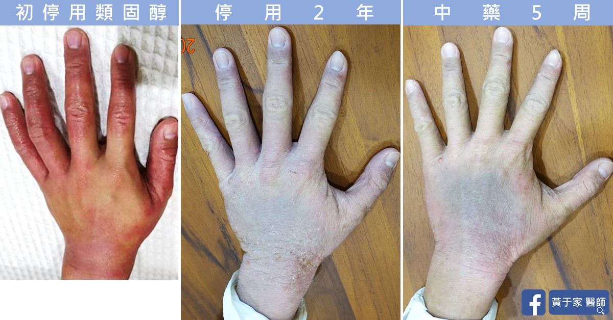 同一位患者手背的三張並排照片,依序標示「初停用類固醇」「停用 2 年」「中藥 5 周」