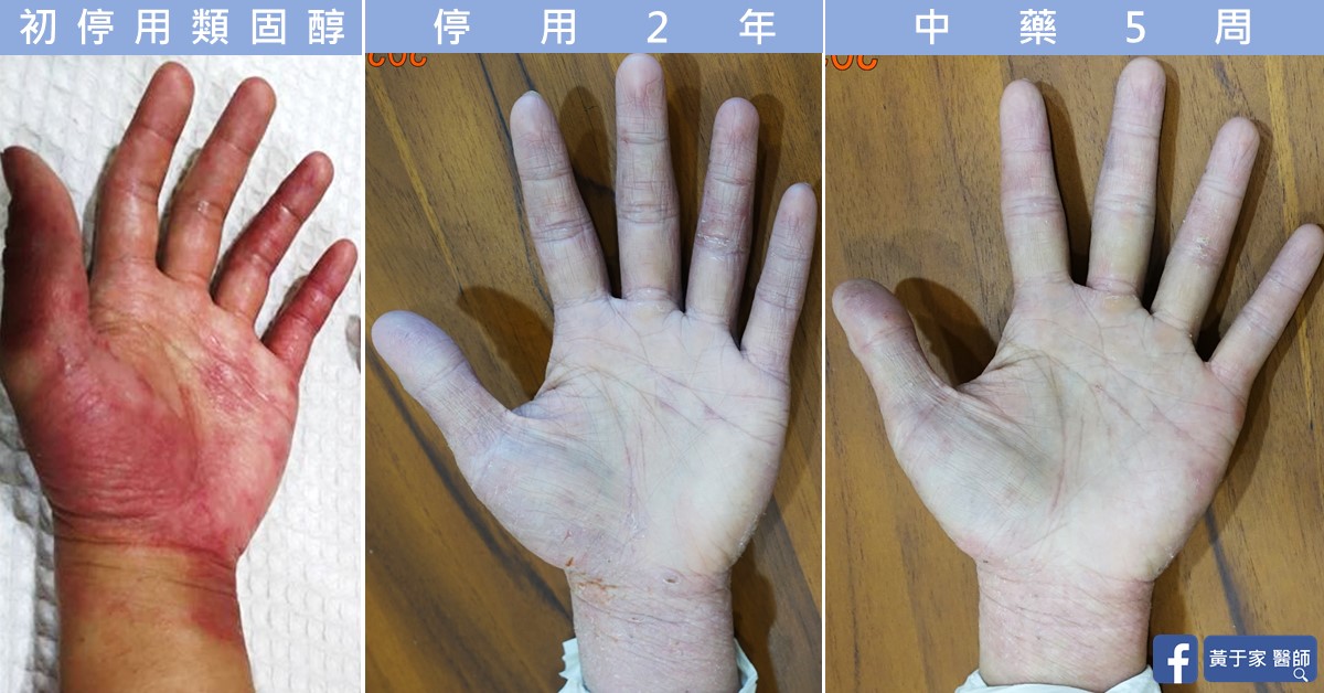 同一位患者皮膚的治療前後比對