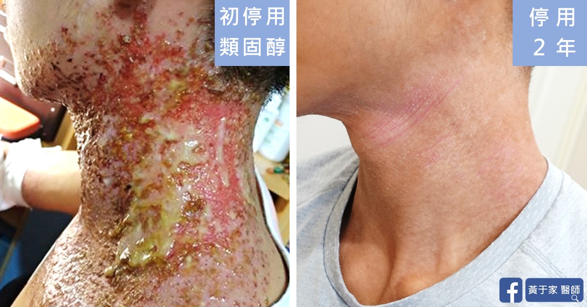 同一位患者皮膚的治療前後比對
